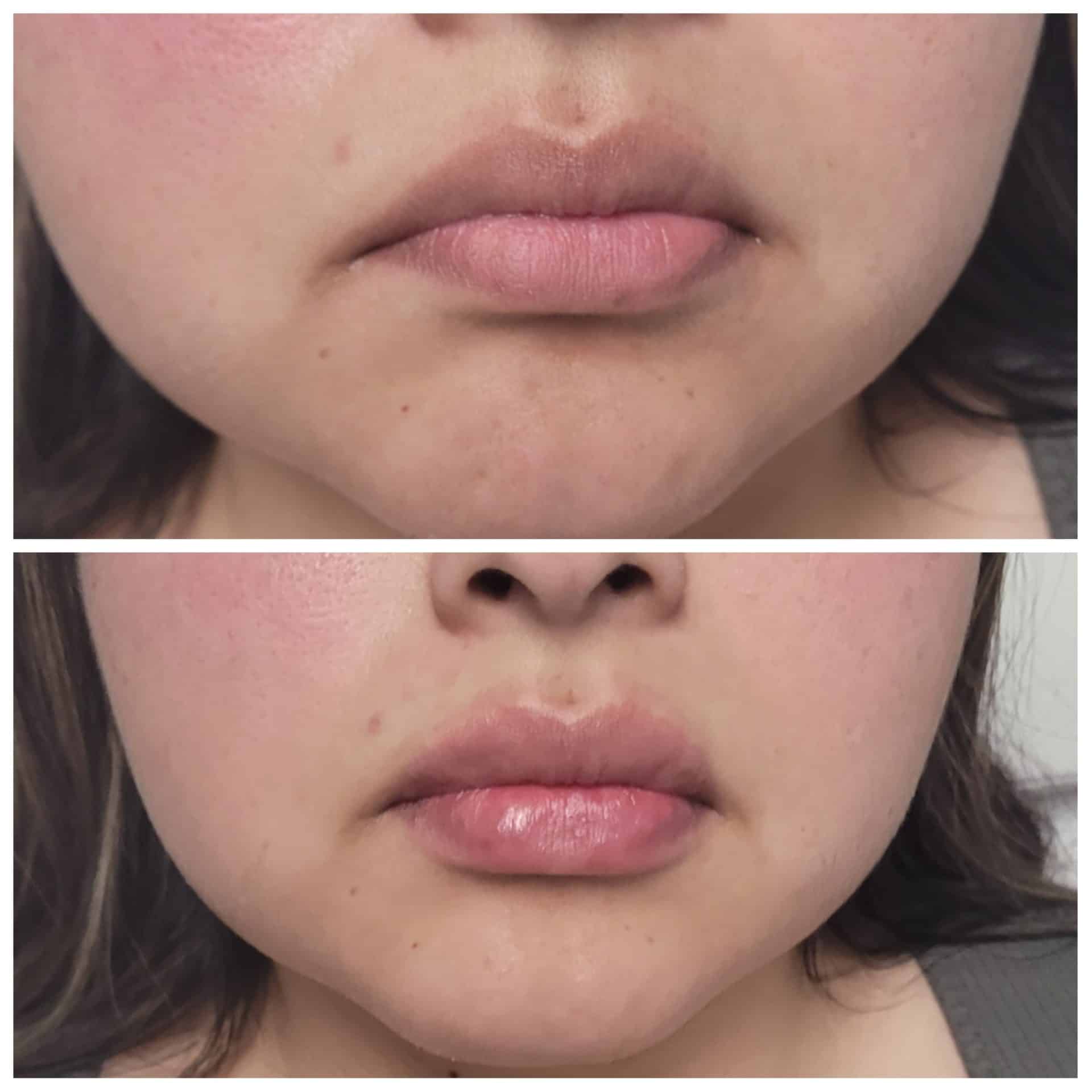 Lip Injection Las Vegas