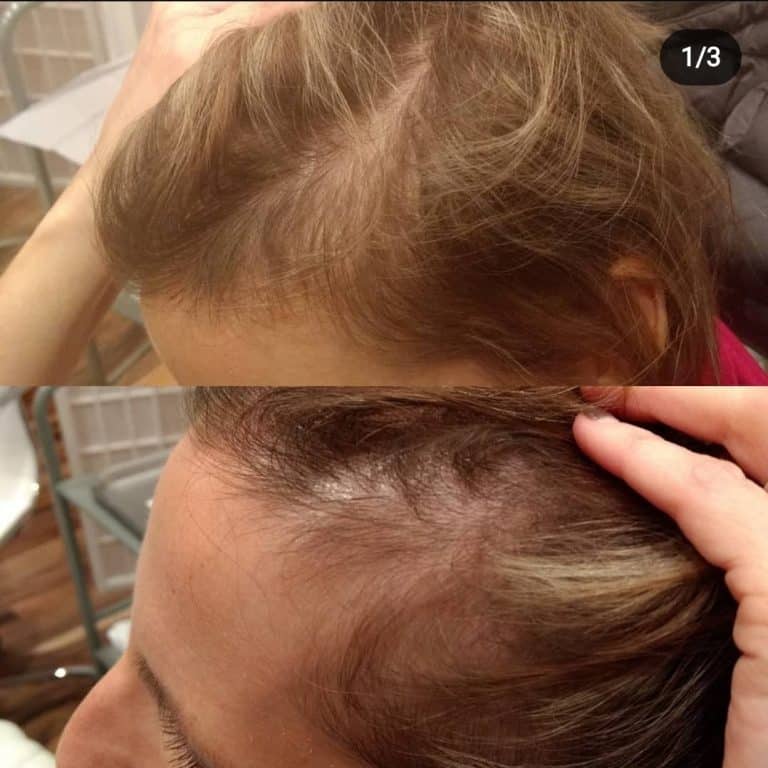chemical peel in racine, botox in kenosha, prf hair restoration