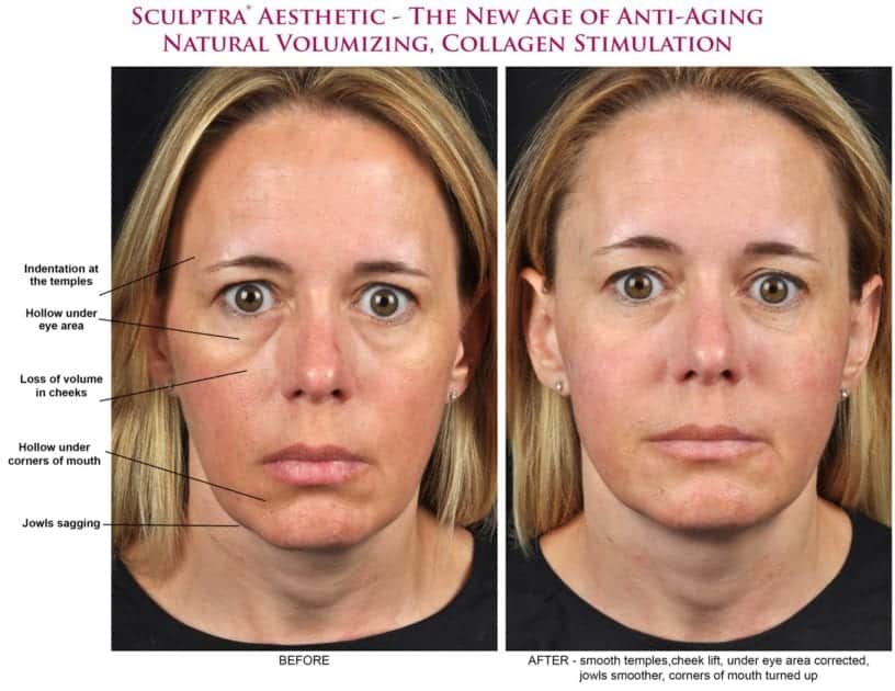 Sculptra Drew & Co Medical Aesthetics Wrinkle Treatment