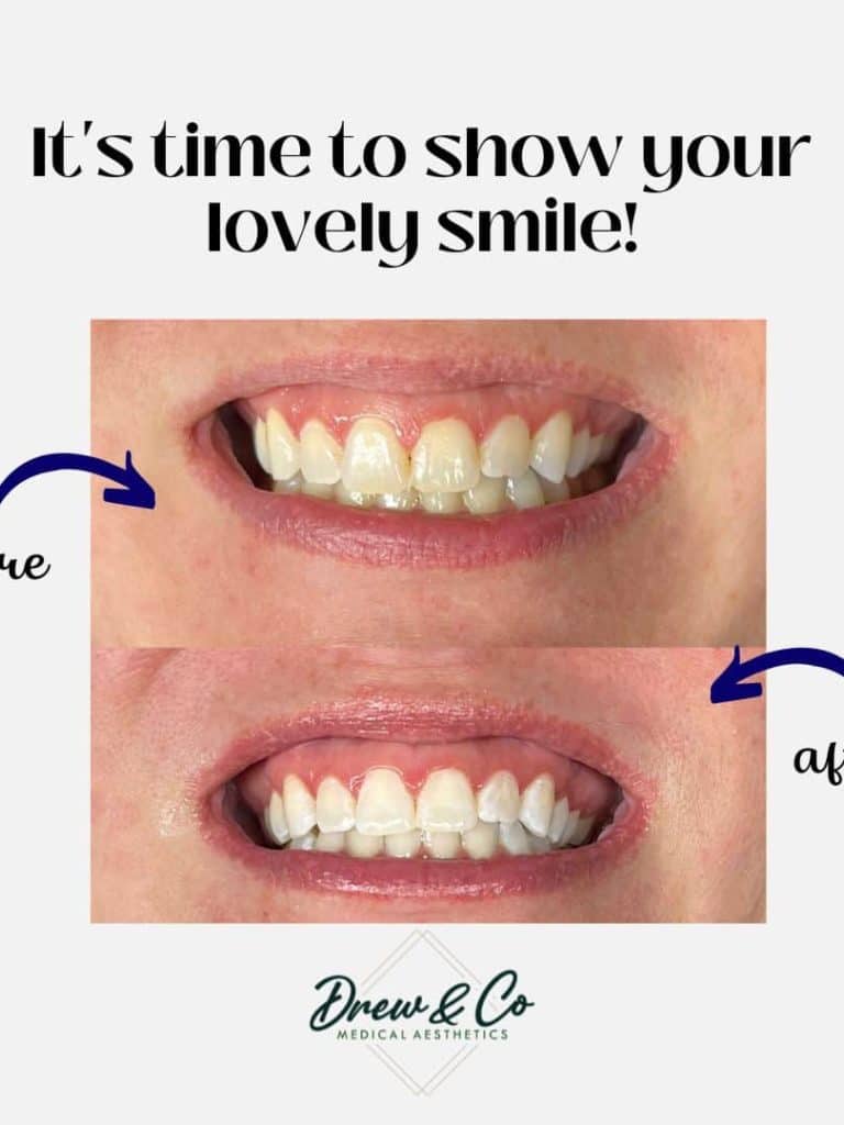 Whiten Teeth in Kenosha, how to Whiten Teeth in Kenosha, where can i Whiten Teeth in Kenosha, how to Whiten Teeth in Kenosha without dentist