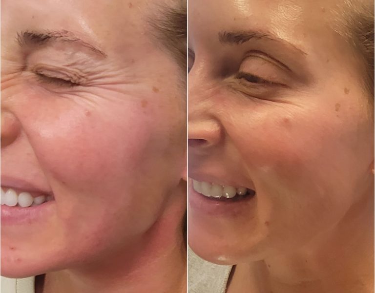Dysport in Kenosha, skin treatments in kenosha, botox near me, dysport near me