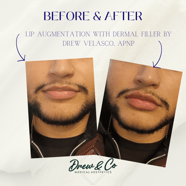 derma filler in Kenosha, derma filler services in Kenosha, Kenosha derma filler
