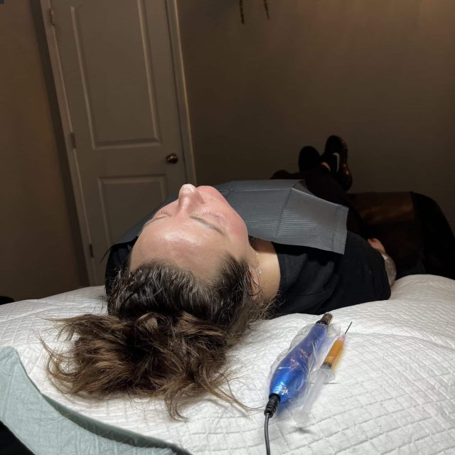 microneedling in Kenosha, Kenosha microneedling, microneedling services in Kenosha