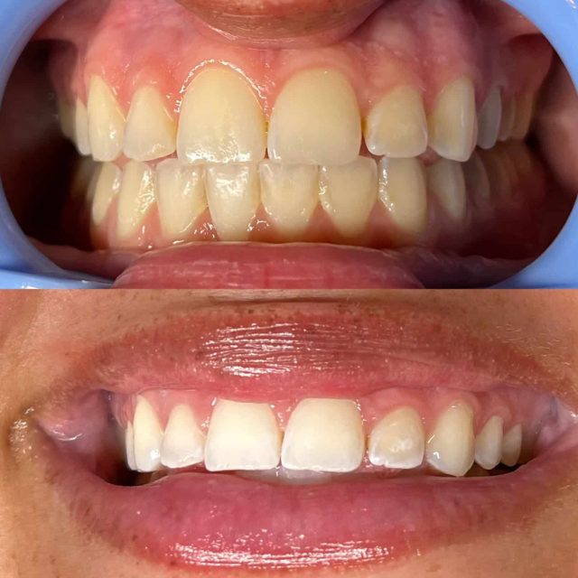 whiten teeth in Kenosha, teeth whitening services in Kenosha, Kenosha teeth whitening