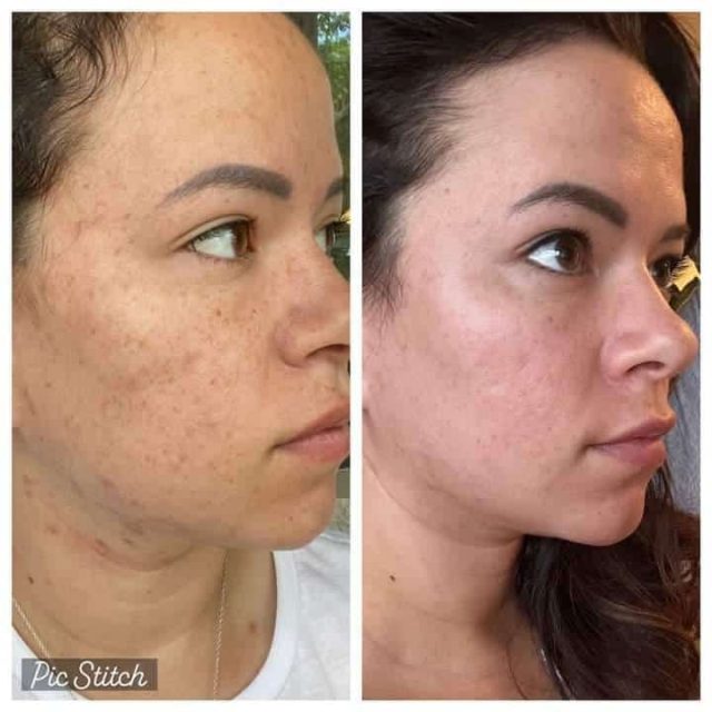 Chemical Peel in Kenosha, Kenosha chemical peel, professional facial services Kenosha