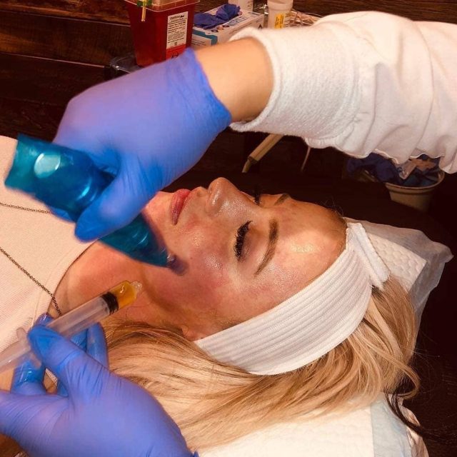derma filler in Kenosha. Kenosha derma filler , derma filler services in Kenosha