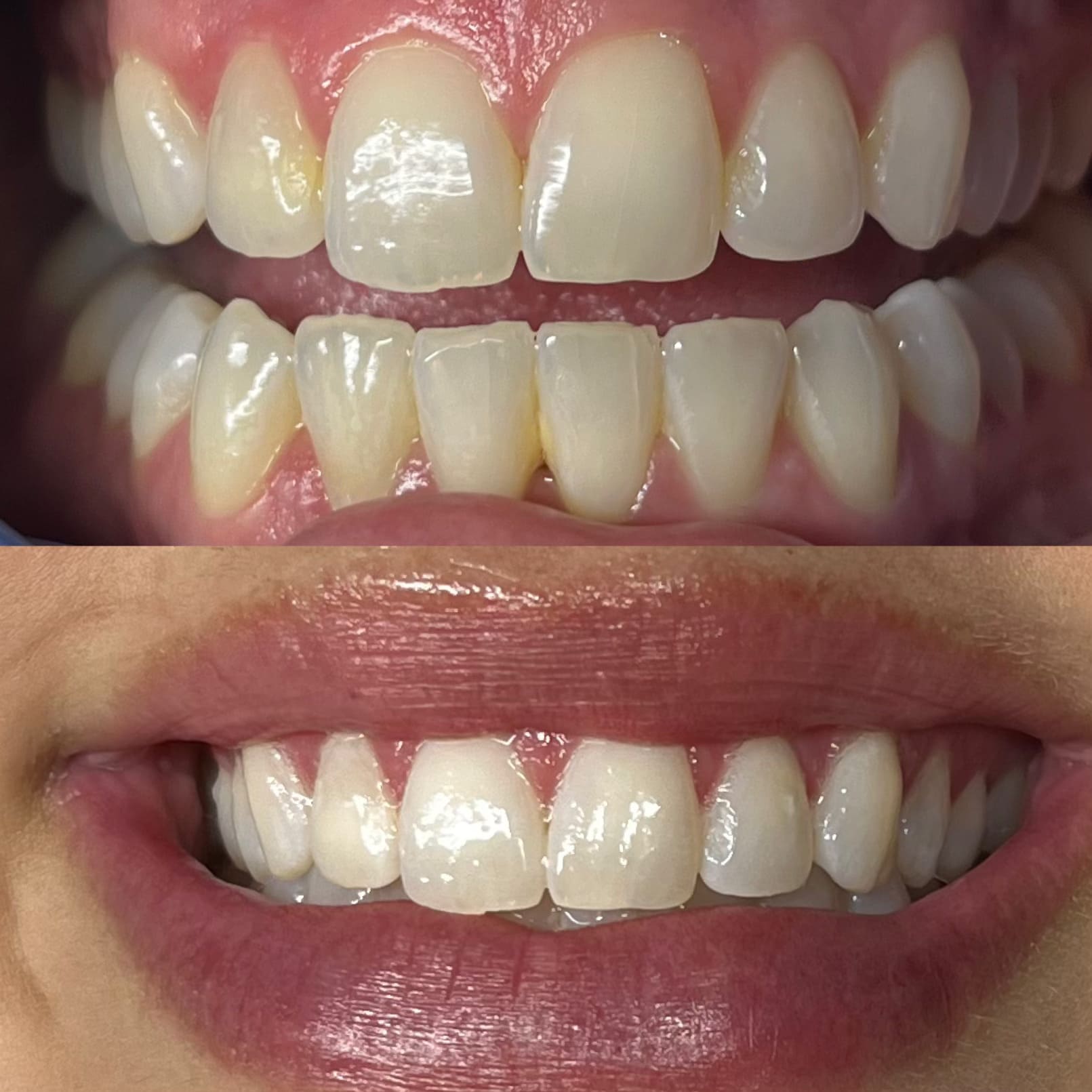 Whiten Teeth in Kenosha Whiten Teeth in Kenosha, whiten teeth near me, whiten my teeth in kenosha