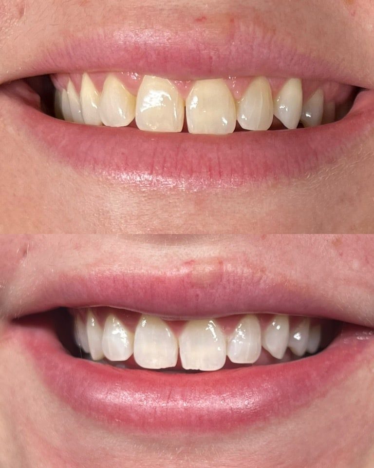 Teeth Whitening teeth whitening, teeth whitening services, teeth whitening near me