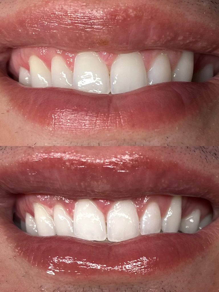 Kenosha teeth whitening, teeth whitening in Kenosha, Kenosha teeth whitening services