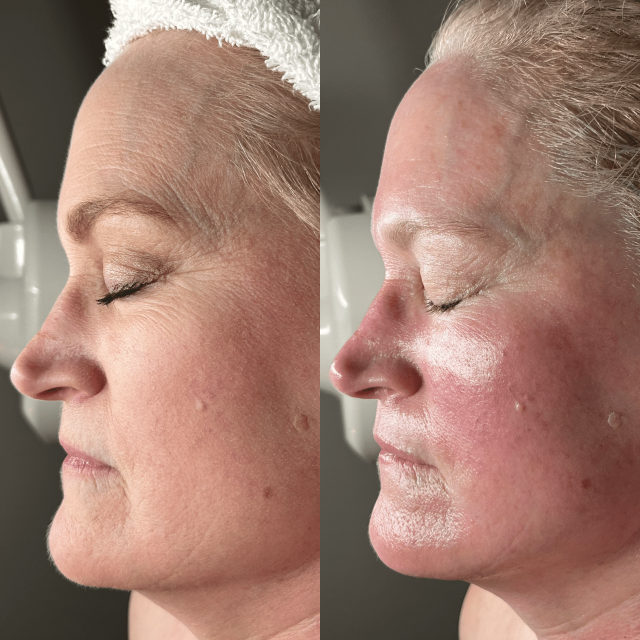 Sculptra in Kenosha, collagen stimulation treatment, wrinkle reduction injections