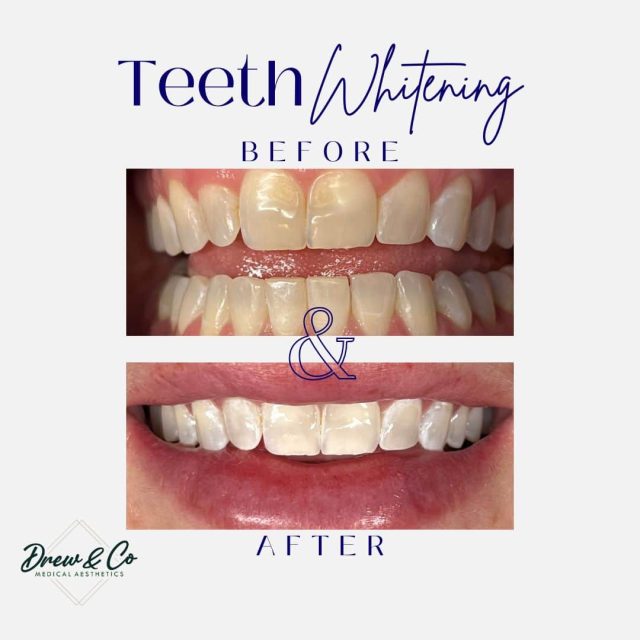 teeth whitening service in Kenosha WI teeth whitening service in Kenosha, professional teeth whitening Kenosha, Kenosha teeth whitening spa
