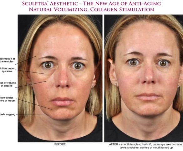 Sculptra in Kenosha, collagen stimulating treatment Kenosha, facial rejuvenation medspa Kenosha WI